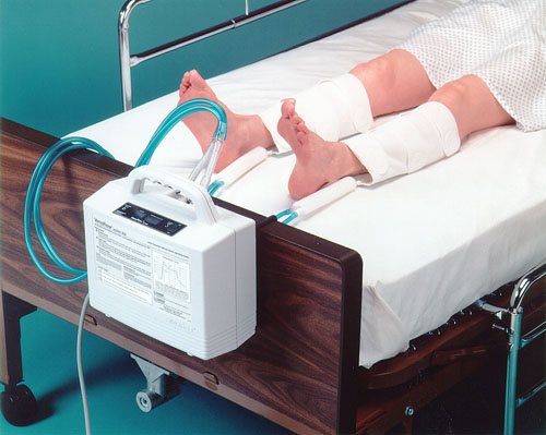 Lymphadema Pumps & Garmets Regular Tubing System * A prophylaxis for deep vein thrombosis * Uses a combination of rapid inflation with graduated sequential compression to significantly increase venous velocity * Asymmetric compression for superior emptying of veins * Includes a pump and tube assembly * This device operates with all Aircast VenaFlow cuffs * Indication: Prevention of thrombus formation * Includes 8' positive lock tubing
