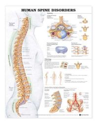 Anatomy Charts This chart illustrates how one's posture changes due to the different types of spinal disorders * The chart shows tumors on the spinal column, ilium, sacrum, and spinal cord, arthritis of the hip, herniated disc, fractures of the vertebrae and sacrum, and the effects of osteoporosis on bones * Laminated * 20